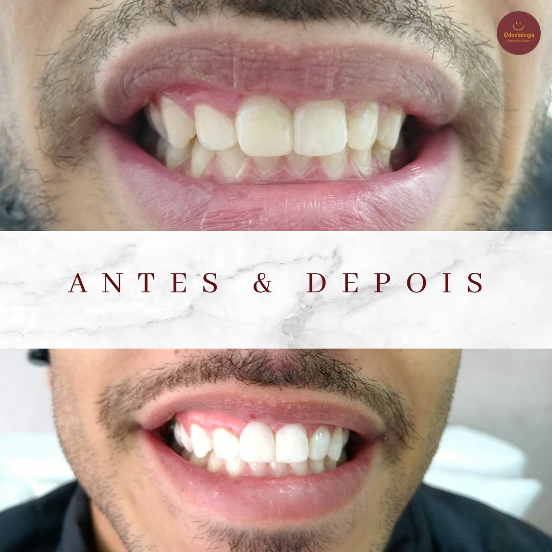 Clareamento Dental