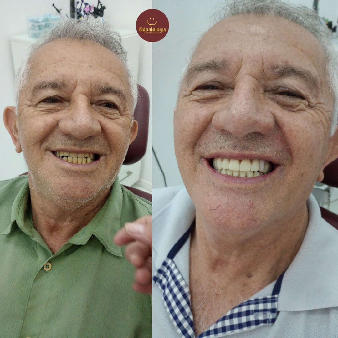 Próteses