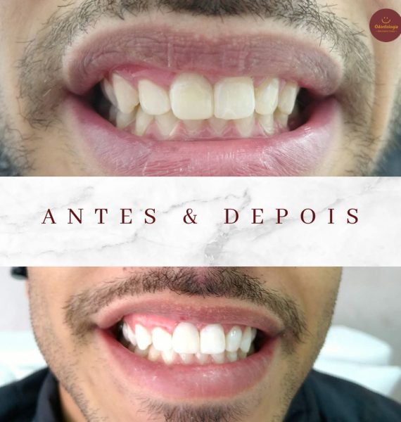 Clareamento Dental