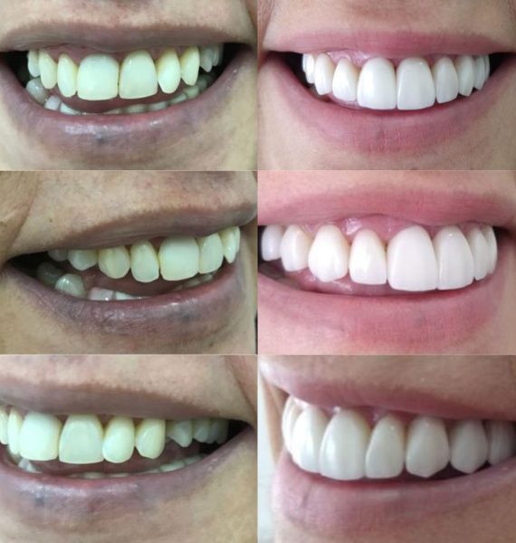 Facetas de Porcelana