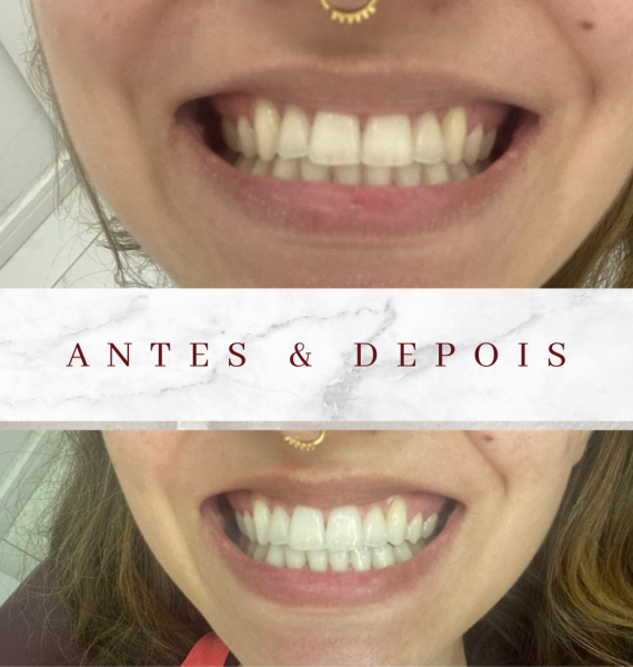 Clareamento Dental